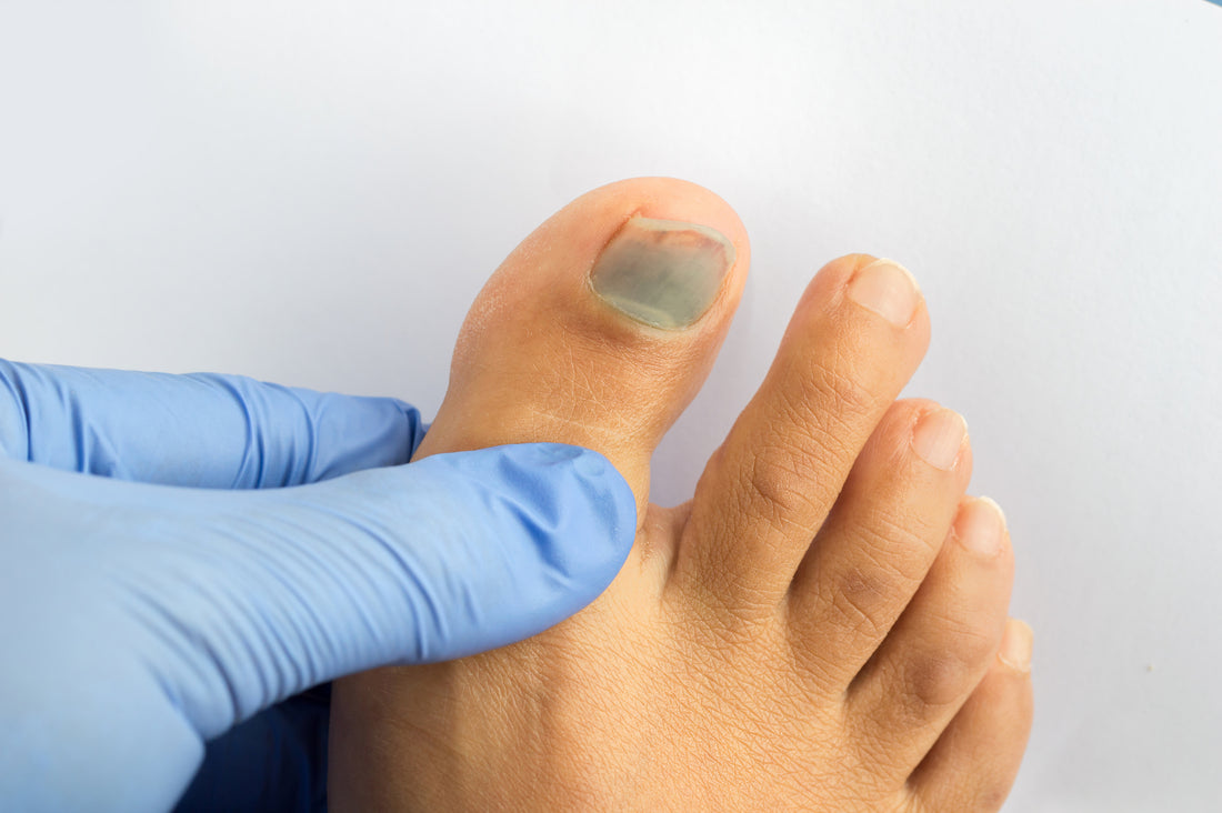 Comprendre et prendre en charge les ongles d'orteil bleus